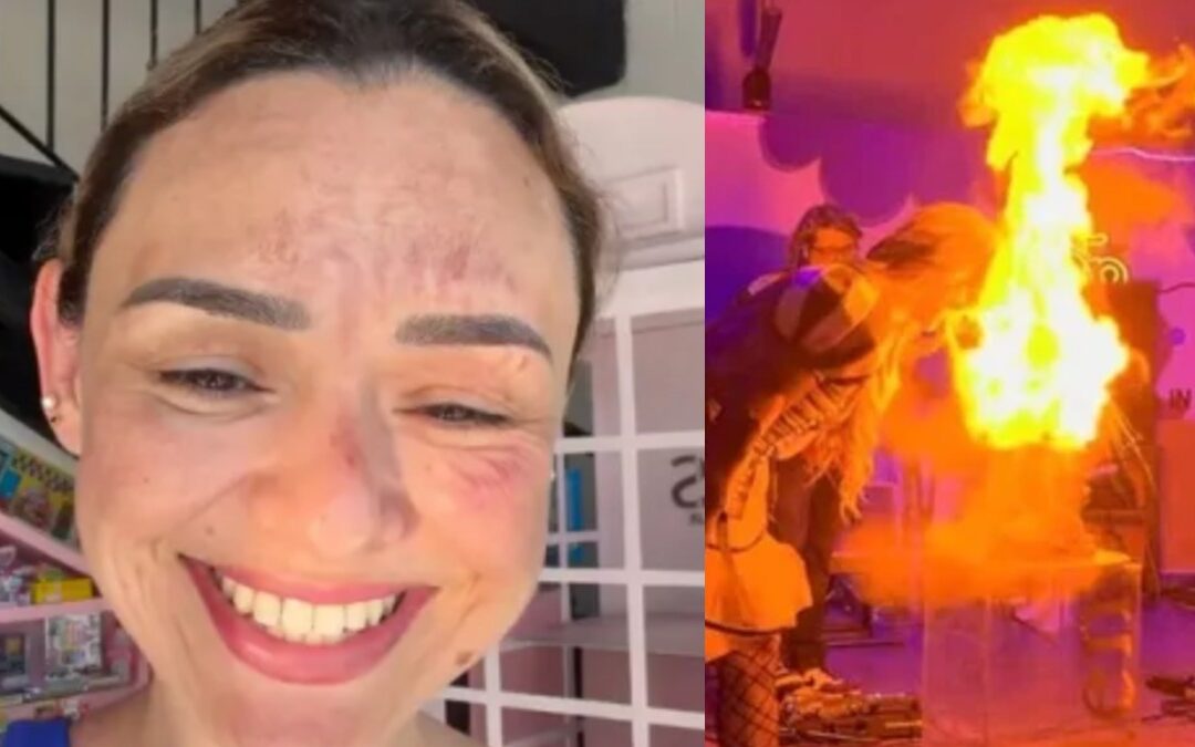 Influencer Arlen Hernández Sufre Quemaduras en el Rostro por un Pastel Explosivo